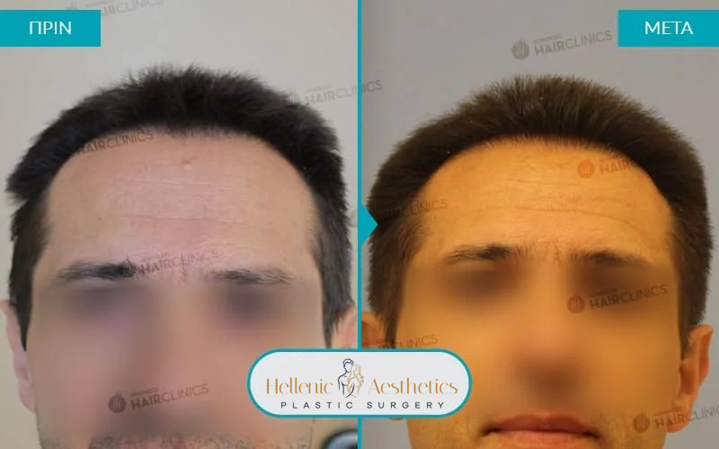 Hair follicles: 786  Hairs: 1468  Months after surgery: 11