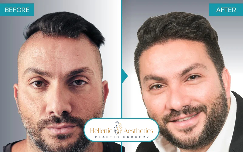 fue-hair-transplant-before-after-results-042-a-(1)