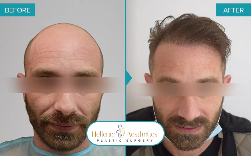 fue-hair-transplant-before-after-results-085-a-(1)
