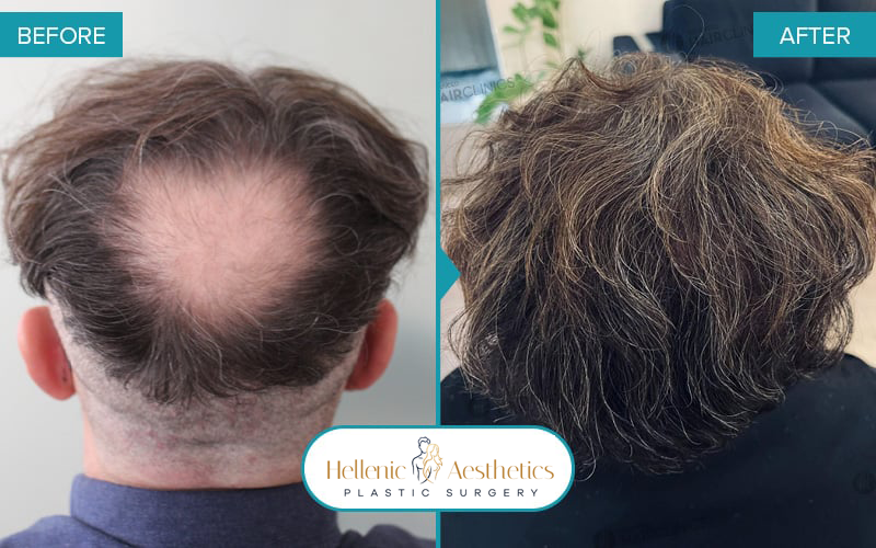 fue-hair-transplant-before-after-results-107-a-(1)