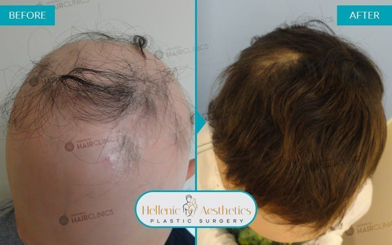 autologous-mesotherapy-hair-loss-treatment-before-after-results-001-a