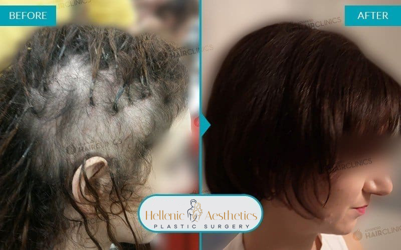 autologous-mesotherapy-hair-loss-treatment-before-after-results-003
