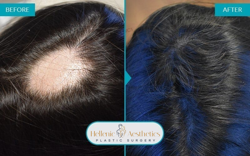 autologous-mesotherapy-hair-loss-treatment-before-after-results-004