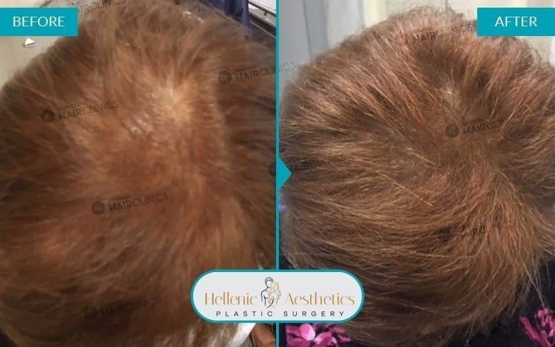 autologous-mesotherapy-hair-loss-treatment-before-after-results-005