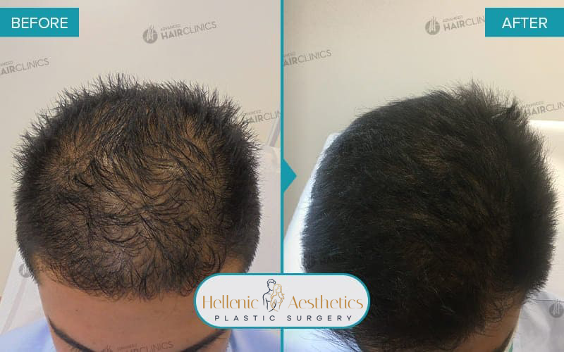 autologous-mesotherapy-hair-loss-treatment-before-after-results-006
