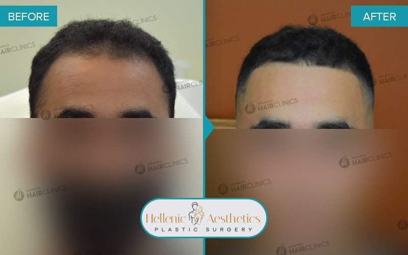 autologous-mesotherapy-hair-loss-treatment-before-after-results-007