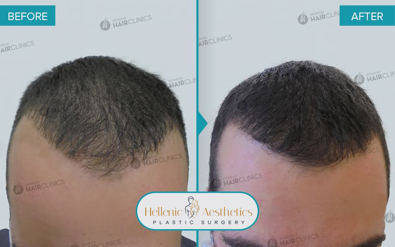 autologous-mesotherapy-hair-loss-treatment-before-after-results-008-a