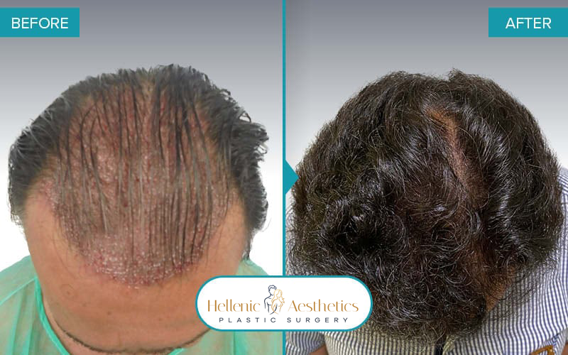 Grafts: 1635  Hair: 3565  Months after the procedure: 12