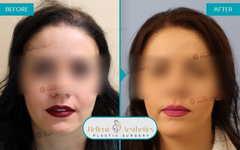 Grafts: 1496  Hair: 3196  Months after the procedure: 12