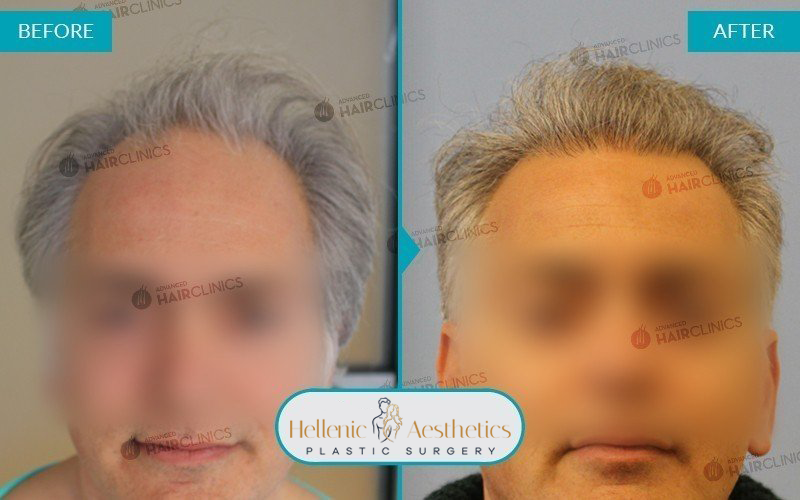 Grafts: 1244  Hair: 2826  Months after the procedure: 12