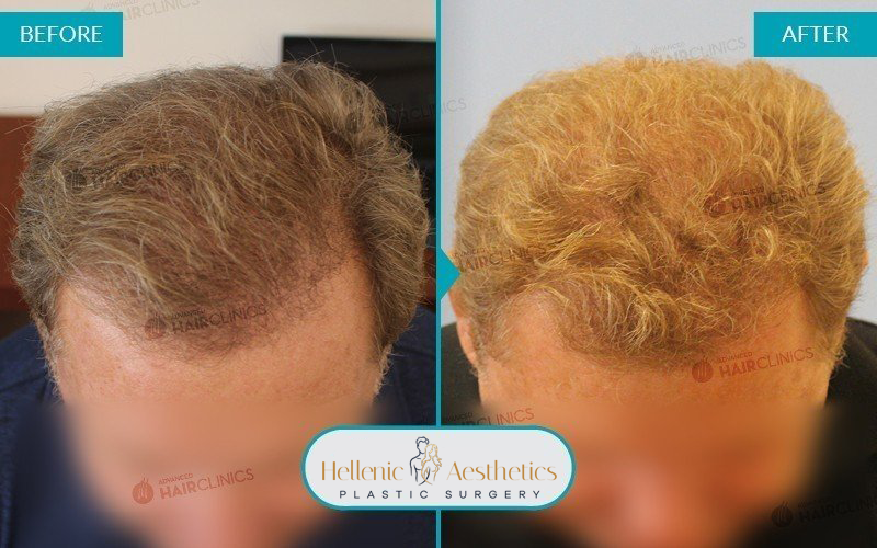 Grafts: 3427  Hair: 6710  Months after the procedure: 9