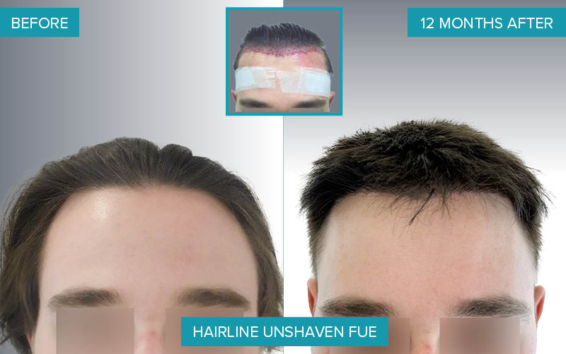 Grafts: 1,656  Hair: 3,477  Months after the procedure: 12