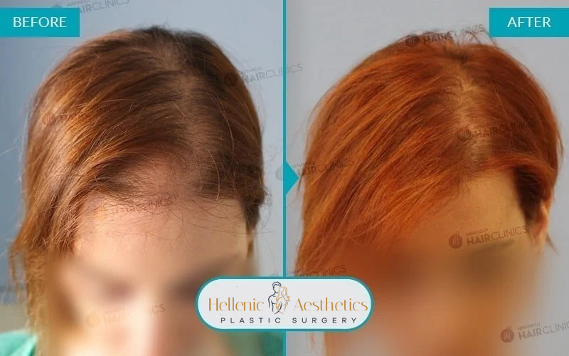 fue-hair-transplant-before-after-results-003-a