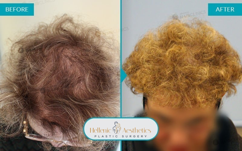 fue-hair-transplant-before-after-results-006-a