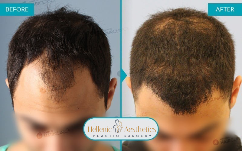 fue-hair-transplant-before-after-results-011-a